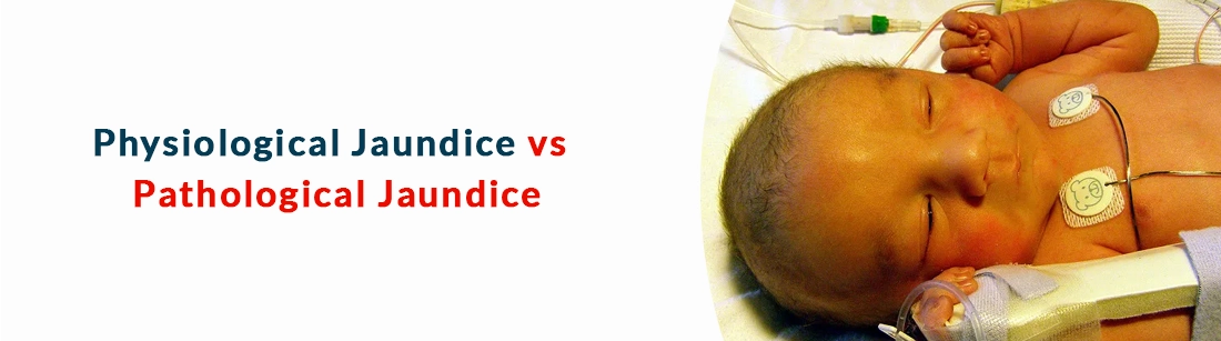 Physiological Jaundice vs Pathological Jaundice